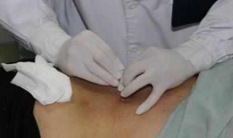 小针刀视频,小针刀治疗技巧与实操解析